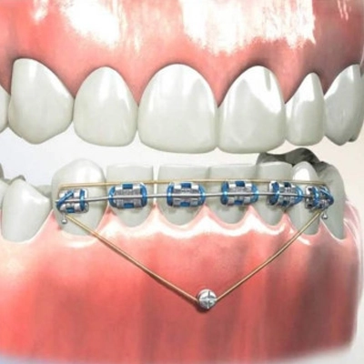 Getting Invisalign Invisalign in Scottsdale